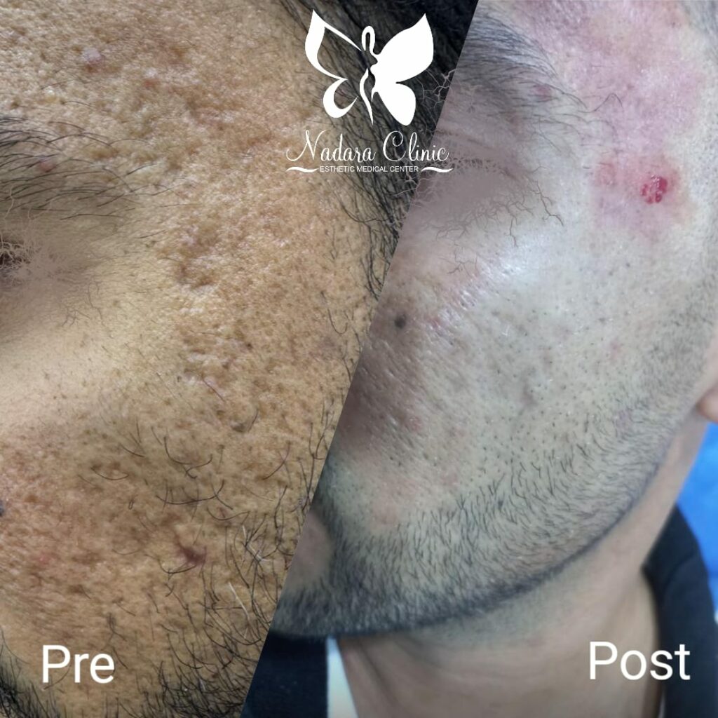 Treatment of large pores before and after